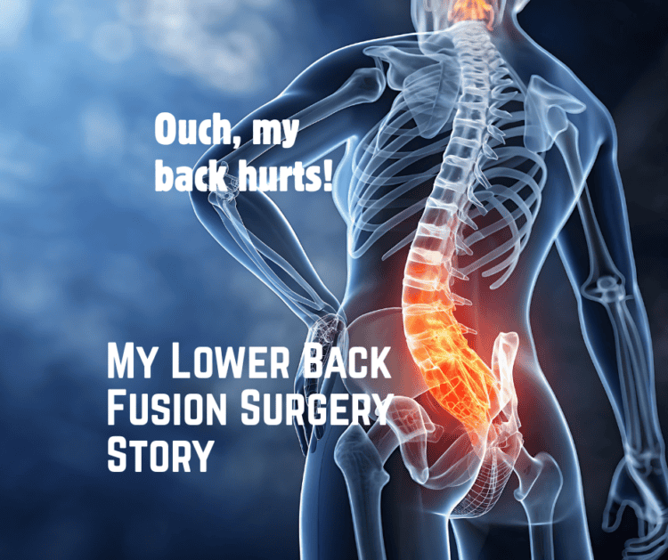 lower back fusion surgery story, midlife health text in white on a photo of a back x ray