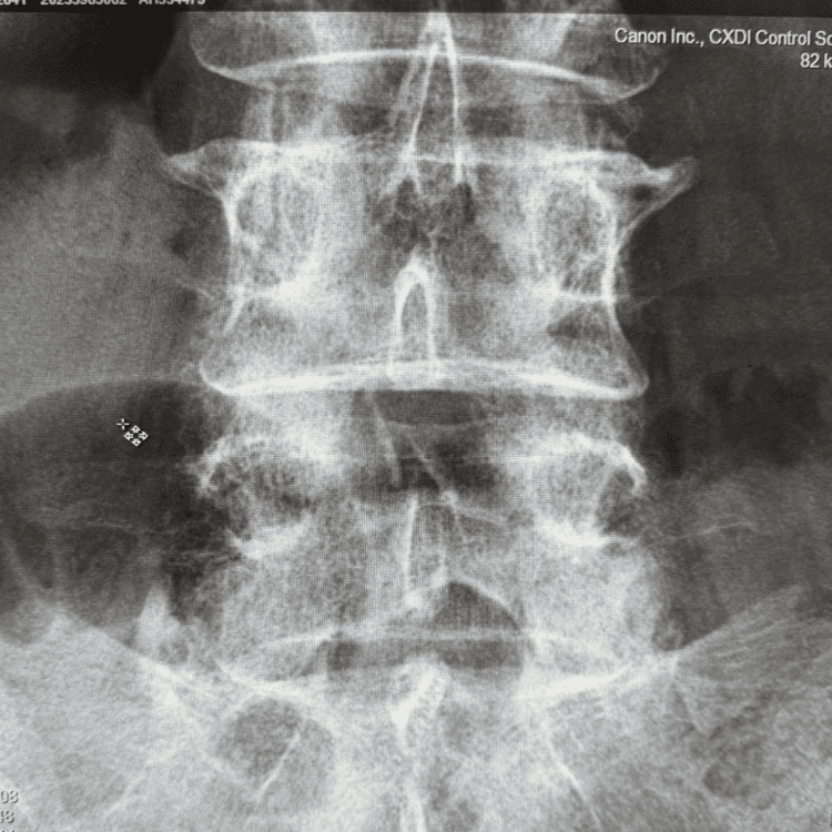 my back x-ray showing L4-L5